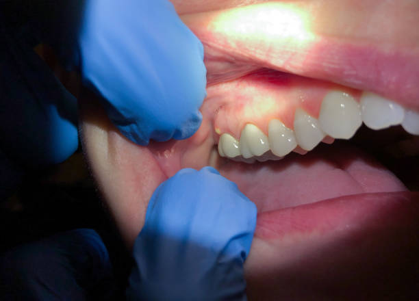 Best Emergency Dentist for Lost Fillings or Crowns in Deer Park, NY